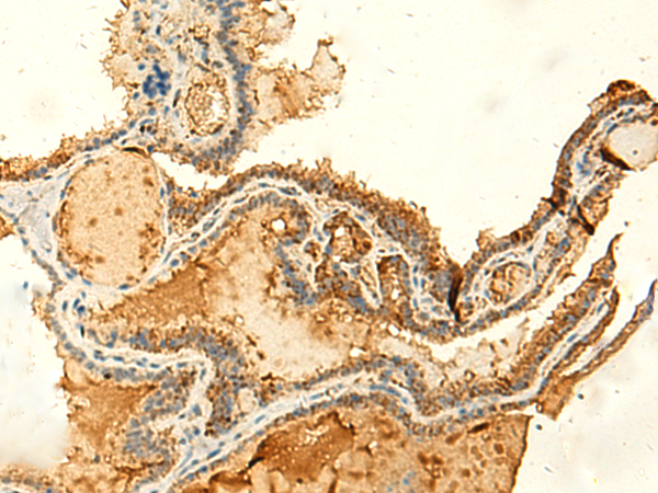 Immunohistochemistry of paraffin-embedded Human thyroid cancer tissue  using KIAA0513 Polyclonal Antibody at dilution of 1:50(×200)