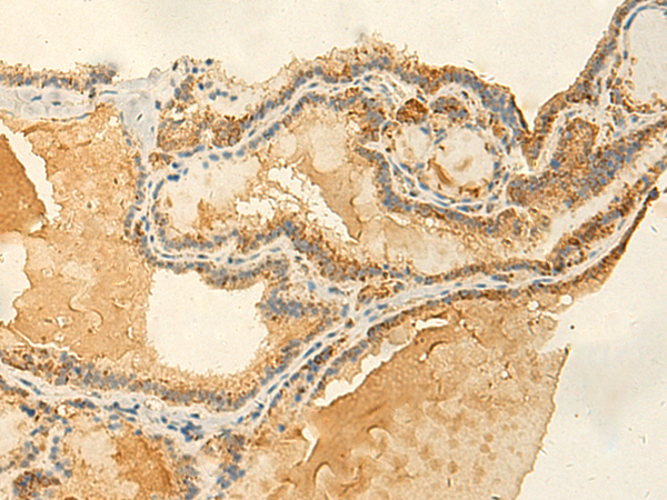 Immunohistochemistry of paraffin-embedded Human thyroid cancer tissue  using RNF148 Polyclonal Antibody at dilution of 1:50(×200)