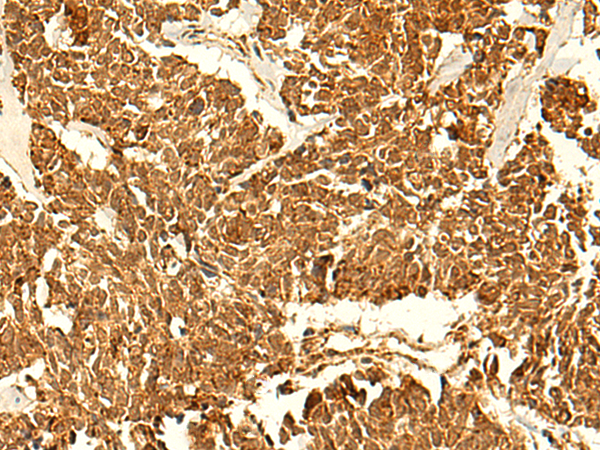 Immunohistochemistry of paraffin-embedded Human lung cancer tissue  using ABHD10 Polyclonal Antibody at dilution of 1:50(×200)