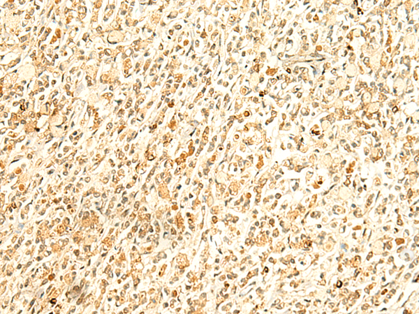 Immunohistochemistry of paraffin-embedded Human gastric cancer tissue  using HMBOX1 Polyclonal Antibody at dilution of 1:50(×200)