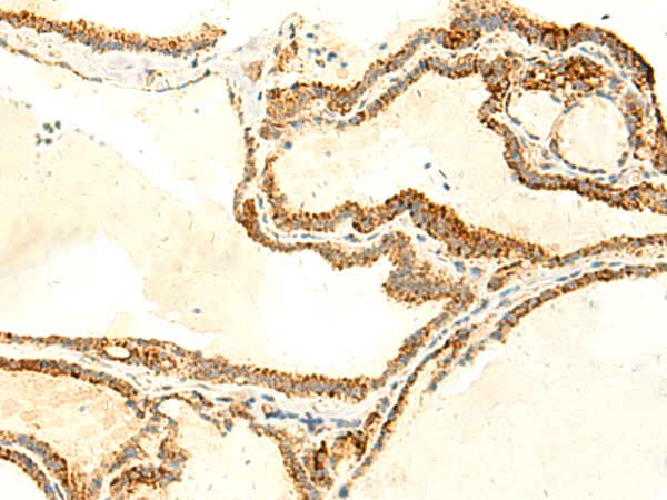 Immunohistochemistry of paraffin-embedded Human thyroid cancer tissue  using NAPRT Polyclonal Antibody at dilution of 1:50(×200)