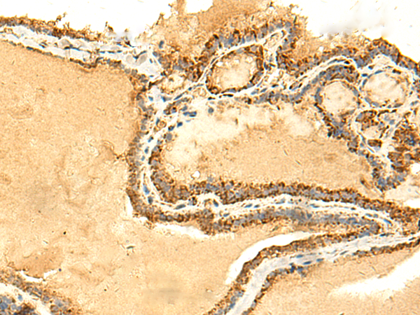 Immunohistochemistry of paraffin-embedded Human thyroid cancer tissue  using ATP5PD Polyclonal Antibody at dilution of 1:50(×200)