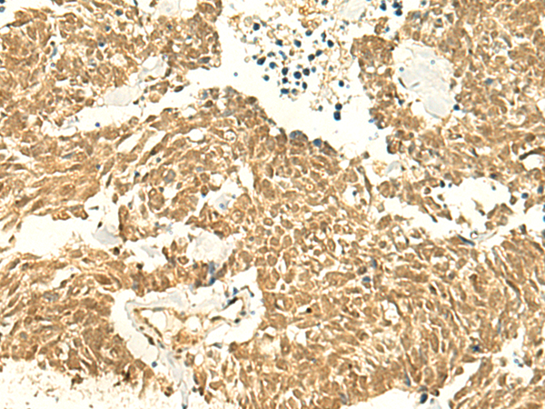 Immunohistochemistry of paraffin-embedded Human lung cancer tissue  using POLR3F Polyclonal Antibody at dilution of 1:50(×200)
