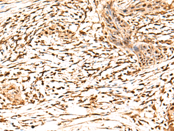 Immunohistochemistry of paraffin-embedded Human esophagus cancer tissue  using RETREG1 Polyclonal Antibody at dilution of 1:50(×200)