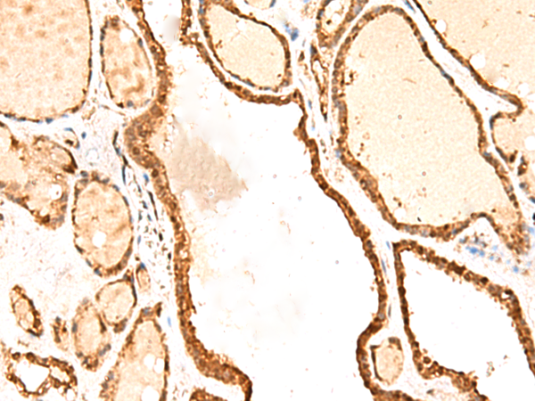 Immunohistochemistry of paraffin-embedded Human thyroid cancer tissue  using RETREG1 Polyclonal Antibody at dilution of 1:50(×200)