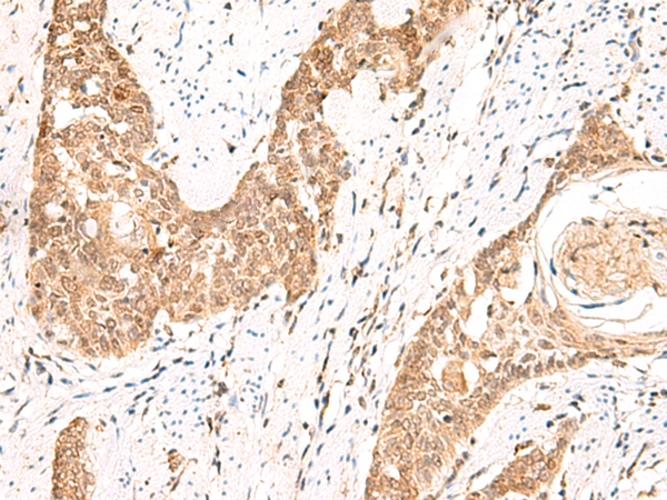 Immunohistochemistry of paraffin-embedded Human esophagus cancer tissue  using PPP1R3C Polyclonal Antibody at dilution of 1:50(×200)