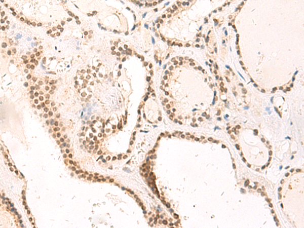 Immunohistochemistry of paraffin-embedded Human thyroid cancer tissue  using TEAD3 Polyclonal Antibody at dilution of 1:50(×200)