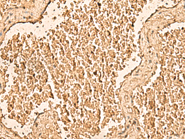 Immunohistochemistry of paraffin-embedded Human gastric cancer tissue  using WDR33 Polyclonal Antibody at dilution of 1:50(×200)