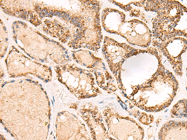 Immunohistochemistry of paraffin-embedded Human thyroid cancer tissue  using ECH1 Polyclonal Antibody at dilution of 1:50(×200)