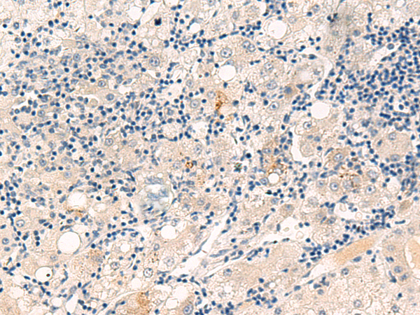 Immunohistochemistry of paraffin-embedded Human liver cancer tissue  using CYYR1 Polyclonal Antibody at dilution of 1:55(×200)