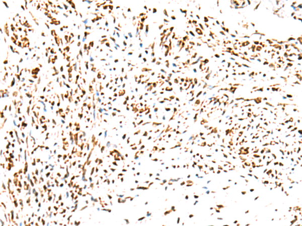 Immunohistochemistry of paraffin-embedded Human cervical cancer tissue  using KCTD13 Polyclonal Antibody at dilution of 1:50(×200)