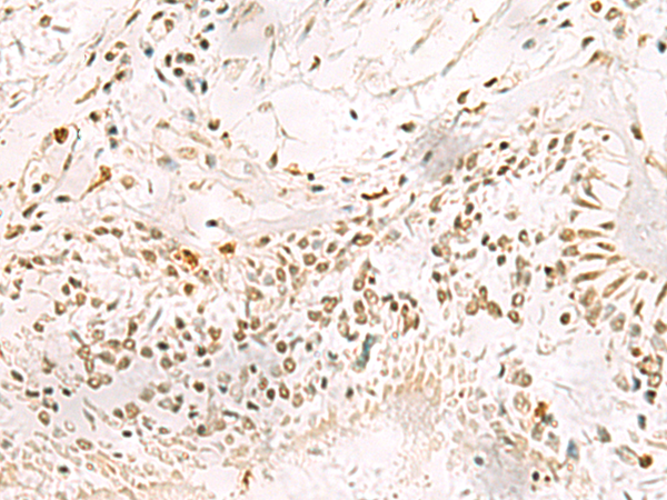 Immunohistochemistry of paraffin-embedded Human lung cancer tissue  using PDS5A Polyclonal Antibody at dilution of 1:90(×200)