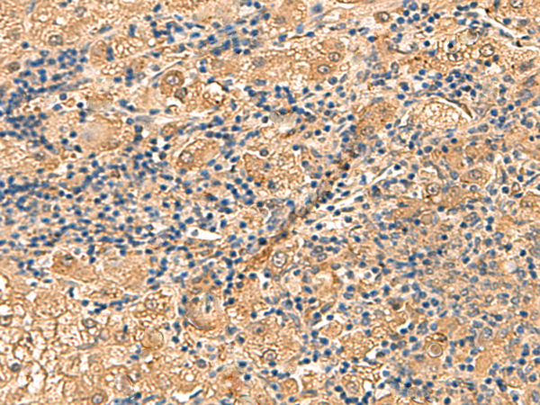 Immunohistochemistry of paraffin-embedded Human liver cancer tissue  using PTH1R Polyclonal Antibody at dilution of 1:55(×200)