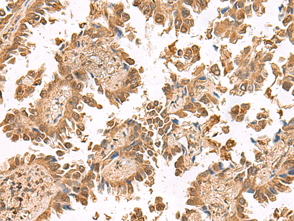 Immunohistochemistry of paraffin-embedded Human lung cancer tissue  using PTH1R Polyclonal Antibody at dilution of 1:55(×200)