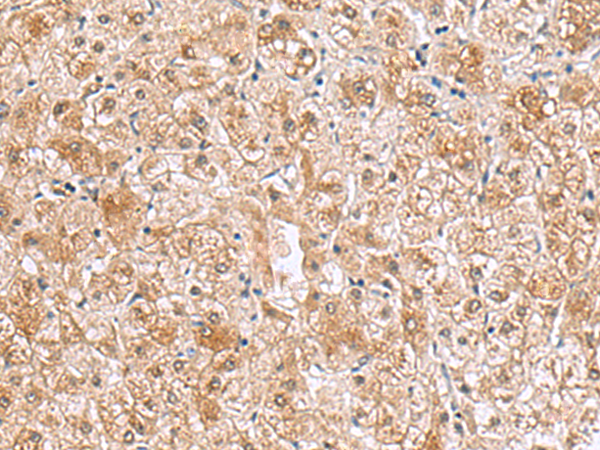 Immunohistochemistry of paraffin-embedded Human liver cancer tissue  using RTKN2 Polyclonal Antibody at dilution of 1:70(×200)