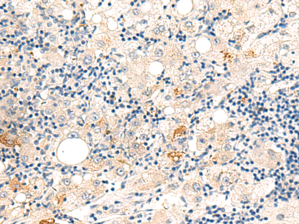 Immunohistochemistry of paraffin-embedded Human liver cancer tissue  using DUT Polyclonal Antibody at dilution of 1:60(×200)