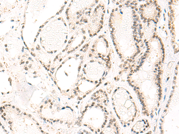 Immunohistochemistry of paraffin-embedded Human thyroid cancer tissue  using DUT Polyclonal Antibody at dilution of 1:60(×200)