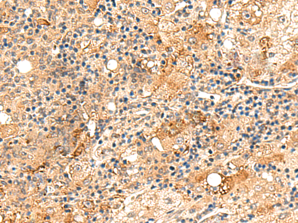 Immunohistochemistry of paraffin-embedded Human liver cancer tissue  using REG1B Polyclonal Antibody at dilution of 1:60(×200)