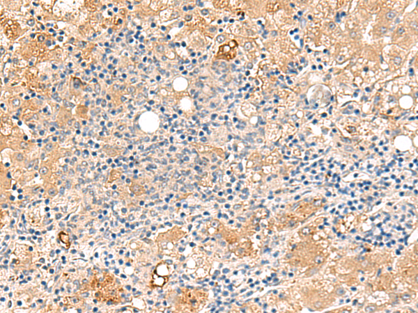 Immunohistochemistry of paraffin-embedded Human liver cancer tissue  using MEST Polyclonal Antibody at dilution of 1:50(×200)