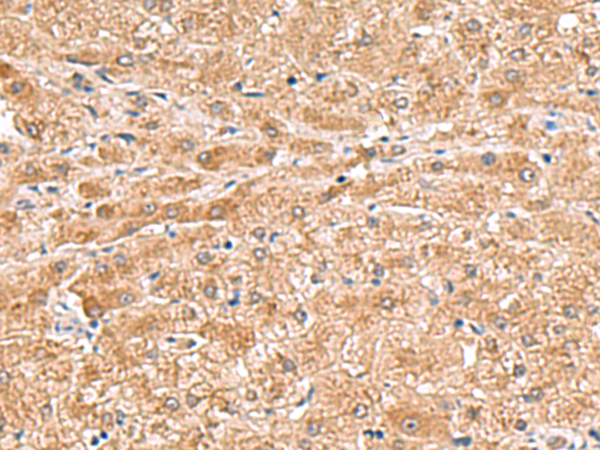 Immunohistochemistry of paraffin-embedded Human liver cancer tissue  using HMGCLL1 Polyclonal Antibody at dilution of 1:70(×200)