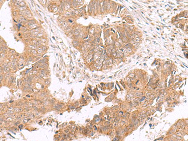 Immunohistochemistry of paraffin-embedded Human colorectal cancer tissue  using HMGCLL1 Polyclonal Antibody at dilution of 1:70(×200)