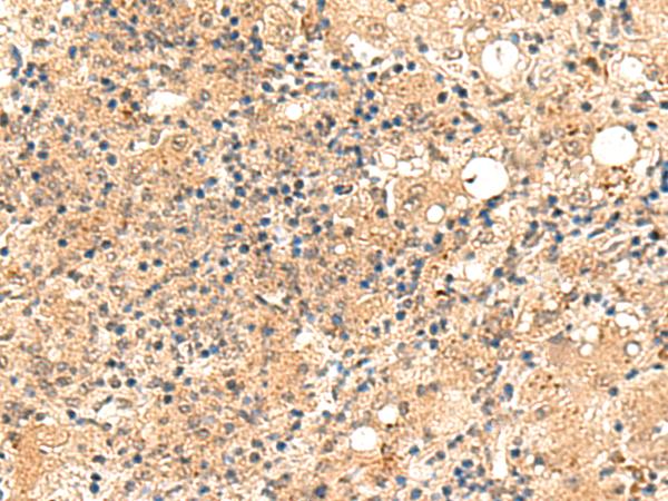 Immunohistochemistry of paraffin-embedded Human esophagus cancer tissue  using ZFYVE27 Polyclonal Antibody at dilution of 1:50(×200)