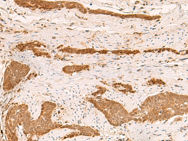 Immunohistochemistry of paraffin-embedded Human liver cancer tissue  using ZFYVE27 Polyclonal Antibody at dilution of 1:50(×200)