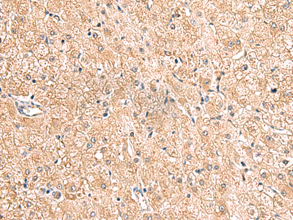 Immunohistochemistry of paraffin-embedded Human liver cancer tissue  using LRG1 Polyclonal Antibody at dilution of 1:80(×200)