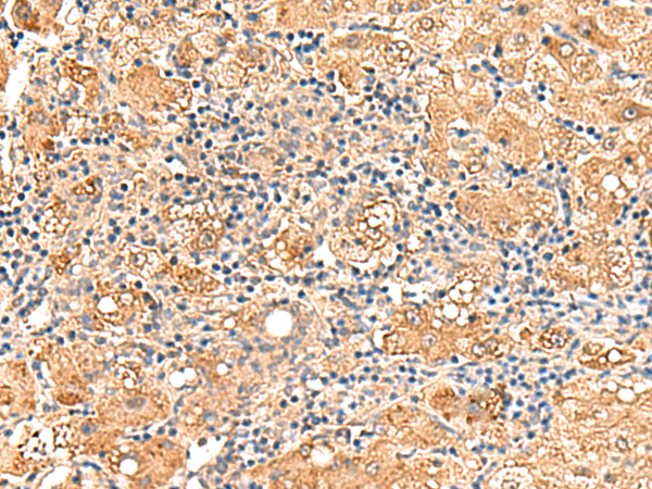 Immunohistochemistry of paraffin-embedded Human liver cancer tissue  using GPD1L Polyclonal Antibody at dilution of 1:60(×200)