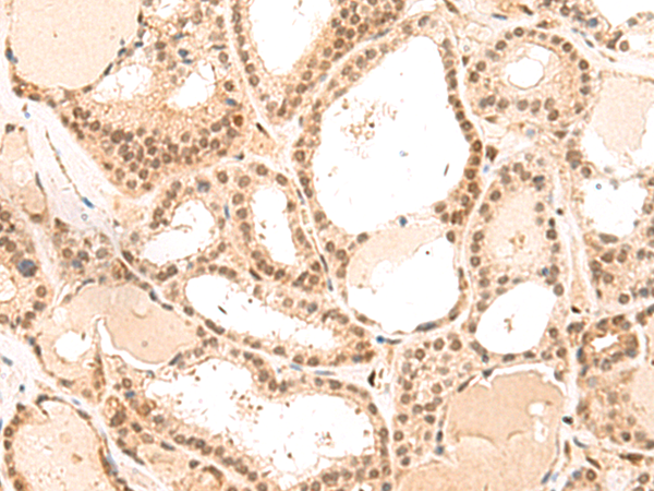 Immunohistochemistry of paraffin-embedded Human thyroid cancer tissue  using MKX Polyclonal Antibody at dilution of 1:50(×200)