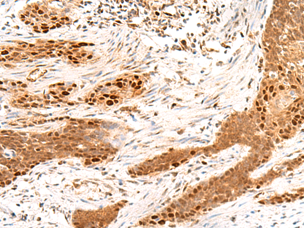 Immunohistochemistry of paraffin-embedded Human esophagus cancer tissue  using MKX Polyclonal Antibody at dilution of 1:50(×200)