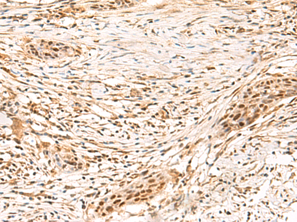 Immunohistochemistry of paraffin-embedded Human esophagus cancer tissue  using SETMAR Polyclonal Antibody at dilution of 1:100(×200)