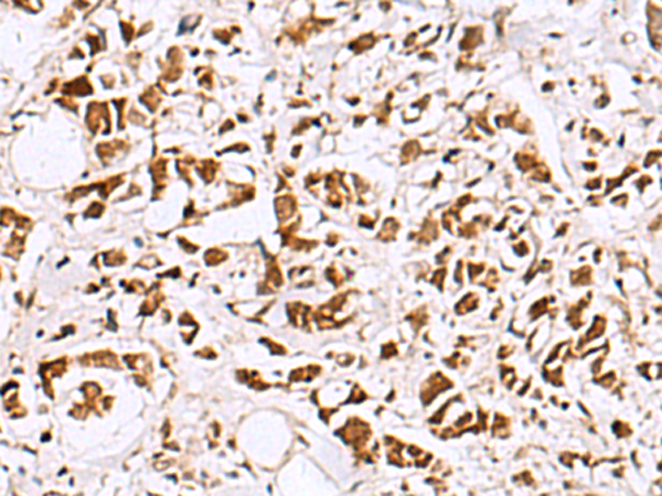 Immunohistochemistry of paraffin-embedded Human breast cancer tissue  using EWSR1 Polyclonal Antibody at dilution of 1:60(×200)