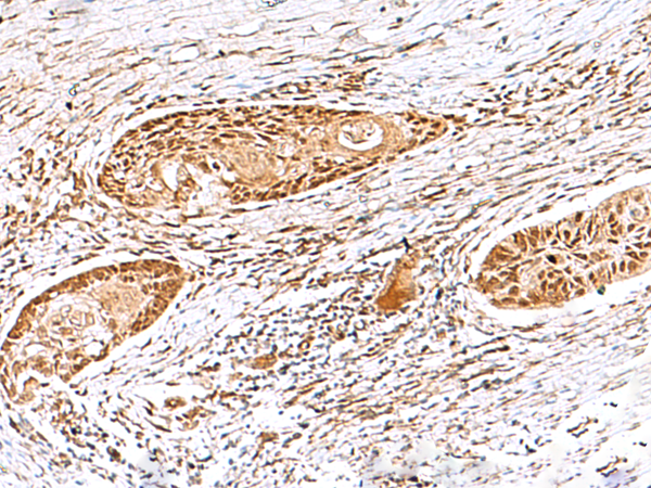 Immunohistochemistry of paraffin-embedded Human esophagus cancer tissue  using EWSR1 Polyclonal Antibody at dilution of 1:60(×200)