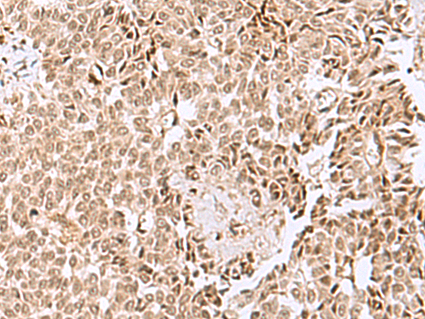 Immunohistochemistry of paraffin-embedded Human ovarian cancer tissue  using ELAC1 Polyclonal Antibody at dilution of 1:50(×200)