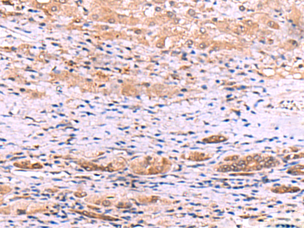 Immunohistochemistry of paraffin-embedded Human liver cancer tissue  using DHPS Polyclonal Antibody at dilution of 1:55(×200)