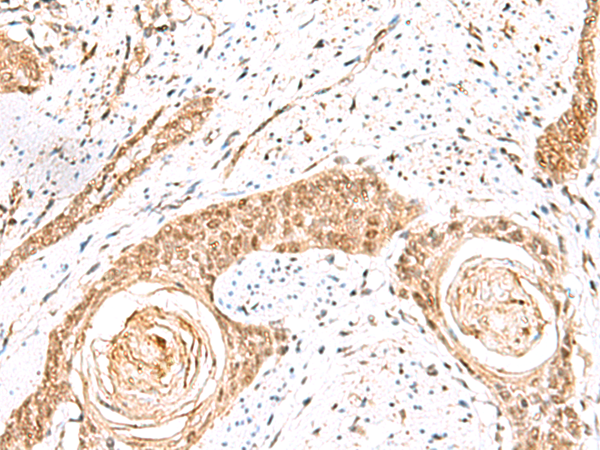 Immunohistochemistry of paraffin-embedded Human esophagus cancer tissue  using ELF3 Polyclonal Antibody at dilution of 1:60(×200)