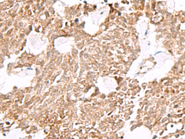 Immunohistochemistry of paraffin-embedded Human lung cancer tissue  using ELF3 Polyclonal Antibody at dilution of 1:60(×200)