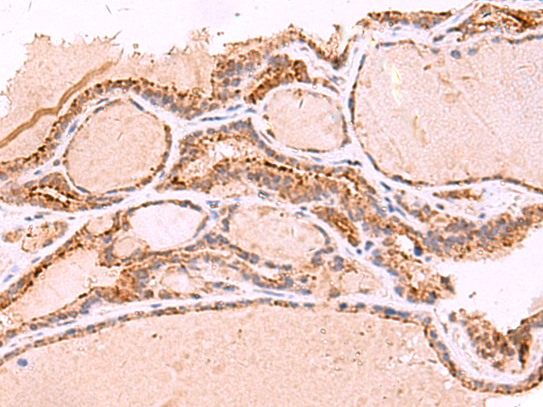 Immunohistochemistry of paraffin-embedded Human thyroid cancer tissue  using RABEPK Polyclonal Antibody at dilution of 1:65(×200)