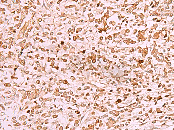 Immunohistochemistry of paraffin-embedded Human gastric cancer tissue  using SAMSN1 Polyclonal Antibody at dilution of 1:50(×200)