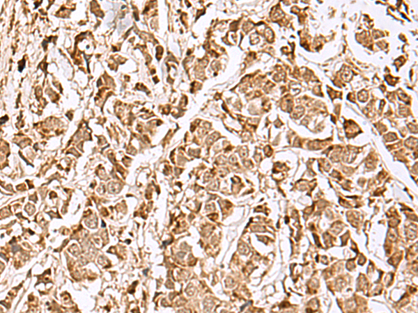 Immunohistochemistry of paraffin-embedded Human breast cancer tissue  using MECR Polyclonal Antibody at dilution of 1:70(×200)