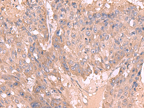 Immunohistochemistry of paraffin-embedded Human liver cancer tissue  using MAGEC2 Polyclonal Antibody at dilution of 1:50(×200)