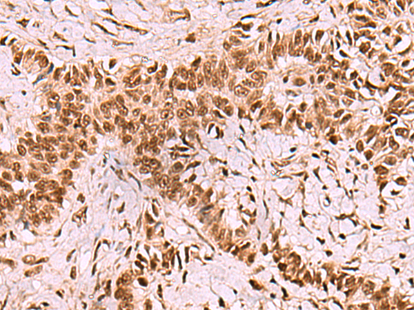 Immunohistochemistry of paraffin-embedded Human ovarian cancer tissue  using LDB1 Polyclonal Antibody at dilution of 1:70(×200)