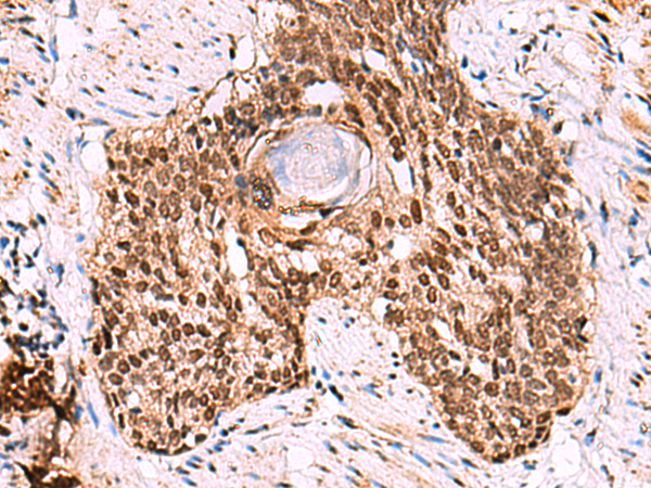 Immunohistochemistry of paraffin-embedded Human esophagus cancer tissue  using LDB1 Polyclonal Antibody at dilution of 1:70(×200)