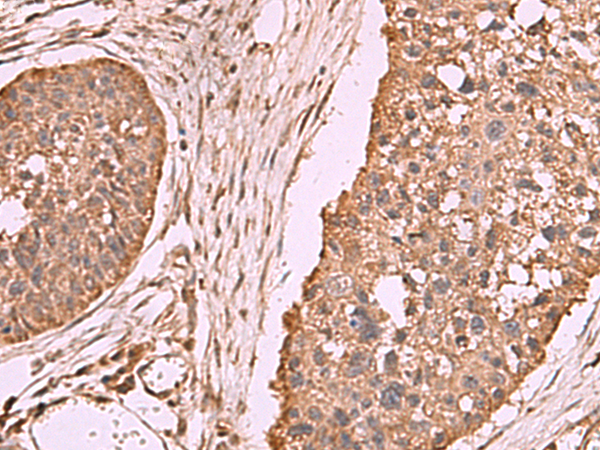 Immunohistochemistry of paraffin-embedded Human esophagus cancer tissue  using PER3 Polyclonal Antibody at dilution of 1:70(×200)