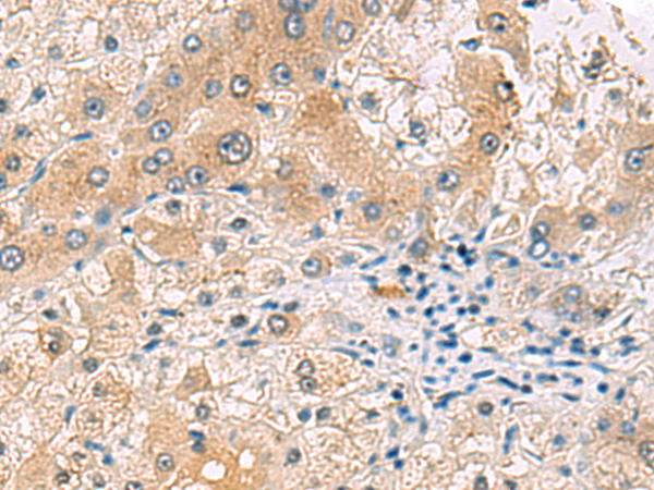 Immunohistochemistry of paraffin-embedded Human liver cancer tissue  using RNF13 Polyclonal Antibody at dilution of 1:60(×200)