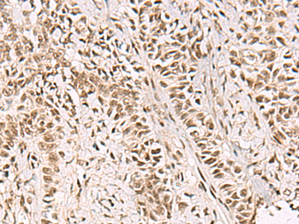 Immunohistochemistry of paraffin-embedded Human ovarian cancer tissue  using GABPB1 Polyclonal Antibody at dilution of 1:55(×200)