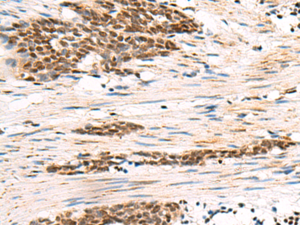 Immunohistochemistry of paraffin-embedded Human esophagus cancer tissue  using GABPB1 Polyclonal Antibody at dilution of 1:55(×200)