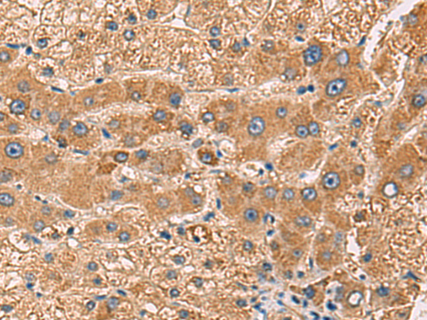 Immunohistochemistry of paraffin-embedded Human liver cancer tissue  using PDHA1 Polyclonal Antibody at dilution of 1:50(×200)