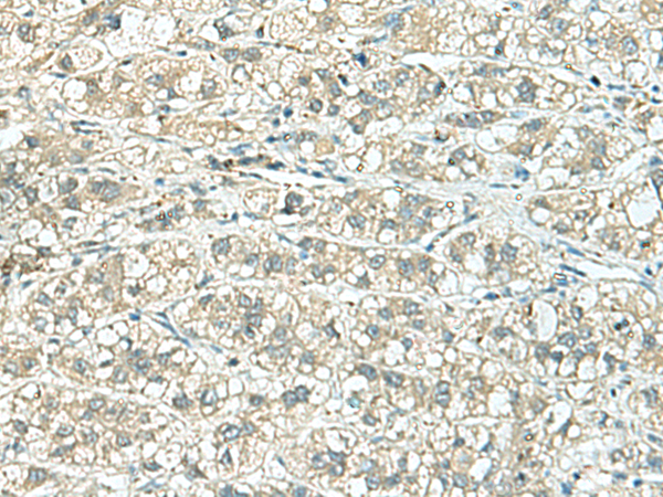 Immunohistochemistry of paraffin-embedded Human liver cancer tissue  using TENT5C Polyclonal Antibody at dilution of 1:110(×200)